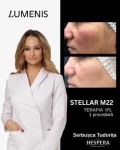 Tratament hiperpigmentare Lumenis M22 la clinica Hespera
